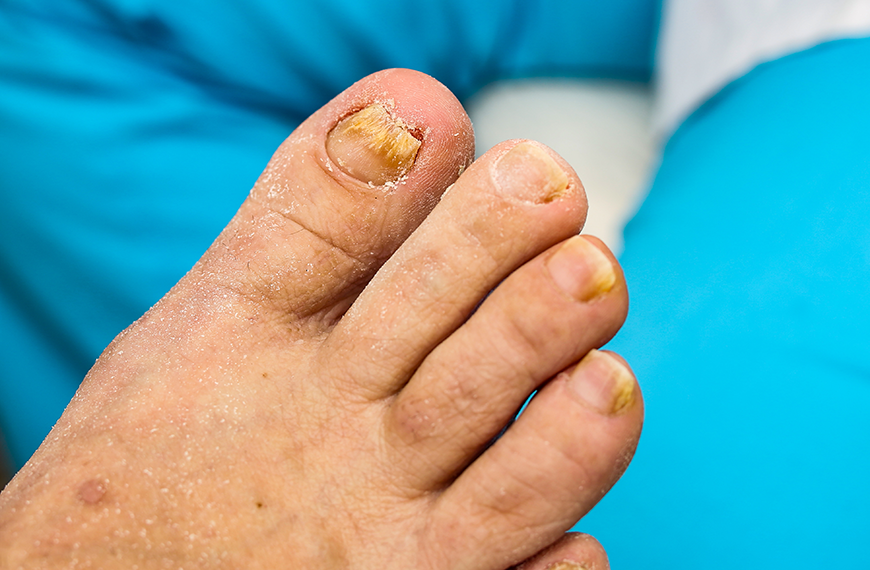 Onychomycosis Understanding and Managing Nail Fungal Infections