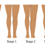 different stages of Lymphedema
