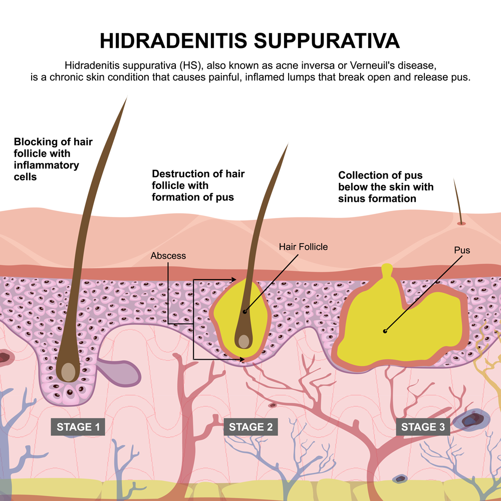 hidradenitis suppurativa illustration