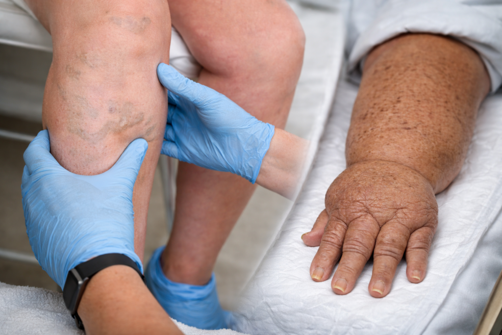 doctors-hands-in-rubber-gloves-examine-the-varicose-veins