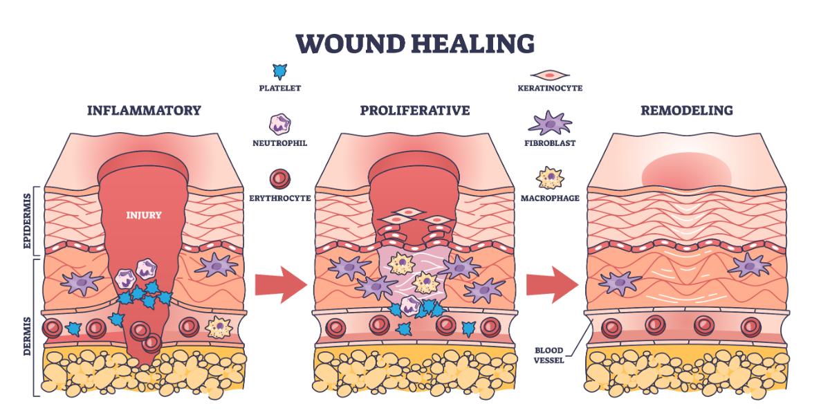 Diagram illustrating the stages of the wound healing process